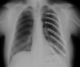 chest xray chest trauma
